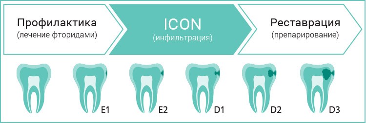 Лечение кариеса ICON Томск Новороссийская фрунзе 119 томск стоматология