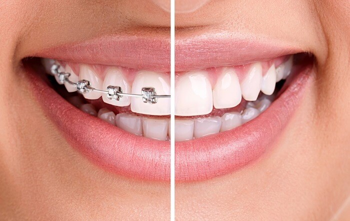 Брекет-системы: путь к ровным зубам и красивой улыбке
