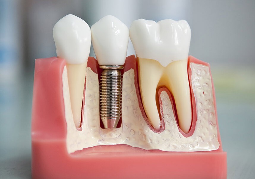 Современные способы восстановления зубного ряда
